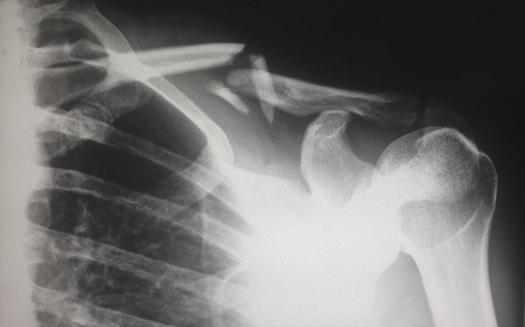 broken bone x ray